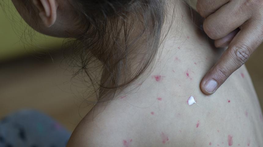 Kızamık vakaları arttı! Aşı olmayan çocuklar hastalığı ağır geçiriyor! "Ölüme kadar gidebilir"