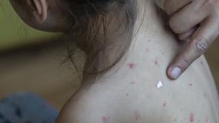 Kızamık vakaları arttı! Aşı olmayan çocuklar hastalığı ağır geçiriyor! Ölüme kadar gidebilir