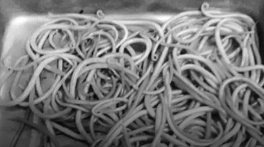 Yüksek ateş ve ishal semptomlarıyla hastanelik oldu! 2 yaşındaki çocuğun bağırsağında yüzlerce canlı solucan çıktı