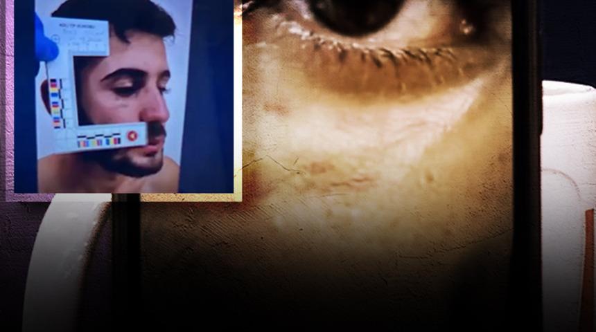Çarpıcı görüntüler ilk kez ortaya çıktı! Soruşturmanın seyrini değiştirecek gelişme: Ağabey Enes Güran'ın yüzündeki morluk ve ısırık izleri...
