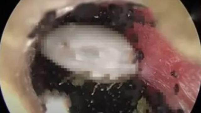 Tuhaf sesler duyduğunu söyleyen 8 yaşındaki çocuğun kulağından kene çıktı! Gördüklerime inanamadım