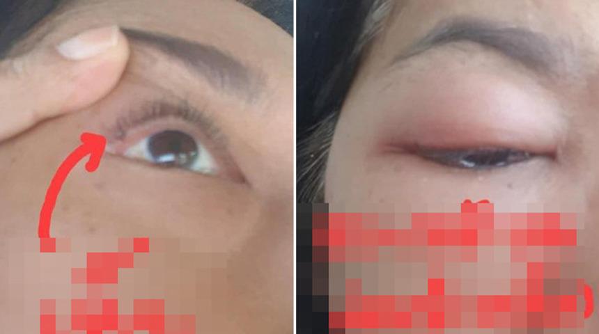 Günlerce gözünde ağrı ve şişlik hissetti! Göz kapağından kene çıktı: Gözü tamamen kapandı