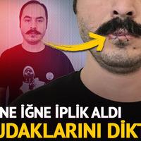 İğne iplik aldı, dudaklarını dikti! 