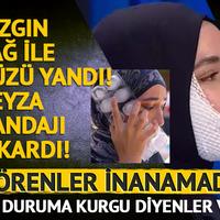 Kızgın yağ ile yüzü yanmıştı! Bandajı çıkardı, Görenler inanamadı