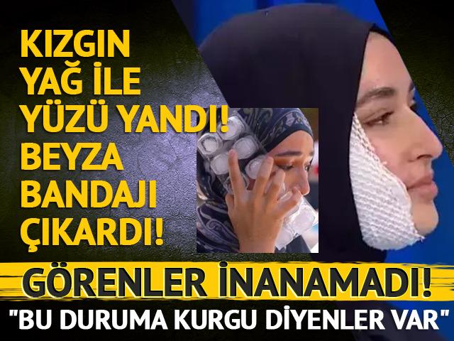 Kızgın yağ ile yüzü yanmıştı! Bandajı çıkardı, Görenler inanamadı