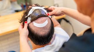 Protez saç nedir? Protez saç ömrü ve bakımı