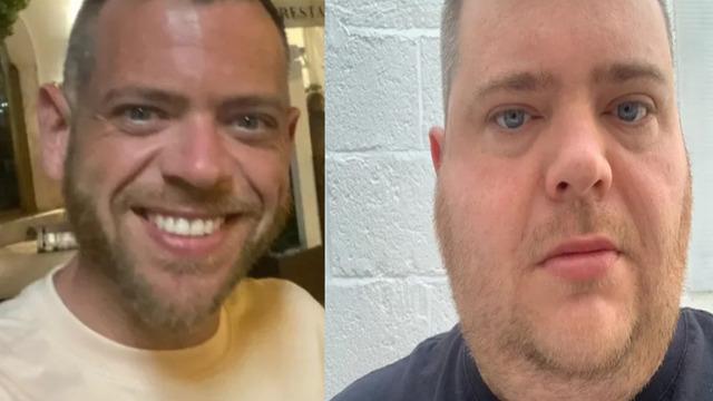 Diş hekiminin hatası bu hale getirdi! İğne çenesinde kırıldı: 17 bin sterlin (yaklaşık 741 bin TL) tazminat kazandı 