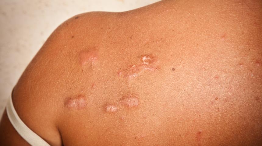 Keloid nedir, neden olur? Keloid nasıl geçer? Keloid belirtileri ve tedavisi