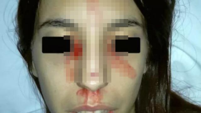 Kelimenin tam anlamıyla 'kan ter' içinde kaldı! Terlediğinde her yeri kesilmiş gibi kanamaya başladı... Doktorları bile şaşırttı