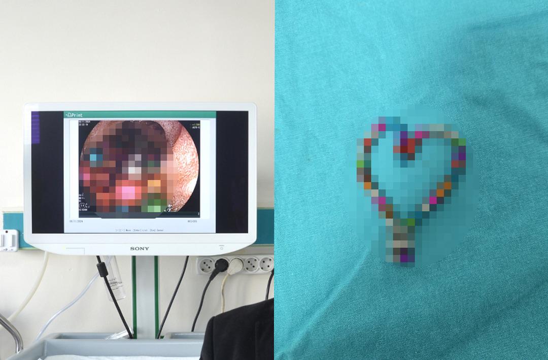 Bursa'da inanılmaz olay! 5 yaşındaki &ccedil;ocuğun bağırsağından &ccedil;ıkanlar şaşkına &ccedil;evirdi: Tam 38 adet!