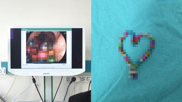 Bursa'da inanılmaz olay! 5 yaşındaki çocuğun bağırsağından çıkanlar şaşkına çevirdi: Tam 38 adet!