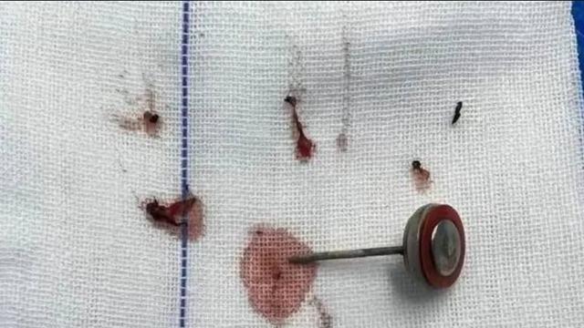 Sadece tek bir ısırık! 2 yaşındaki pili ısıran çocuk hastanelik oldu: Önce patlama sonra çığlık...