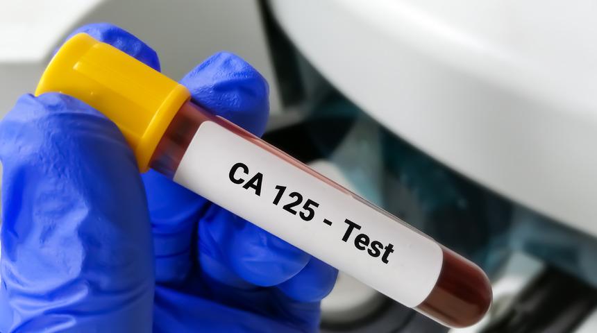 CA 125 nedir, neden yükselir? CA 125 kaç olursa tehlikeli? CA 125 testi ve CA 125 yüksekliği nedenleri