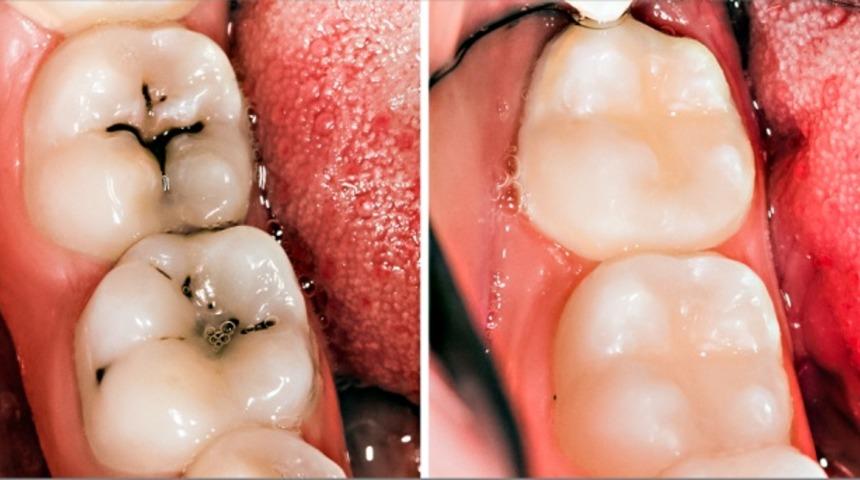 Diş çürüğünden kurtulmanın yolu bu kadar basitmiş