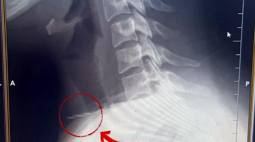 Kadının boğazına iğne saplandı! 1 saat s&uuml;ren ameliyatla &ccedil;ıkarıldı