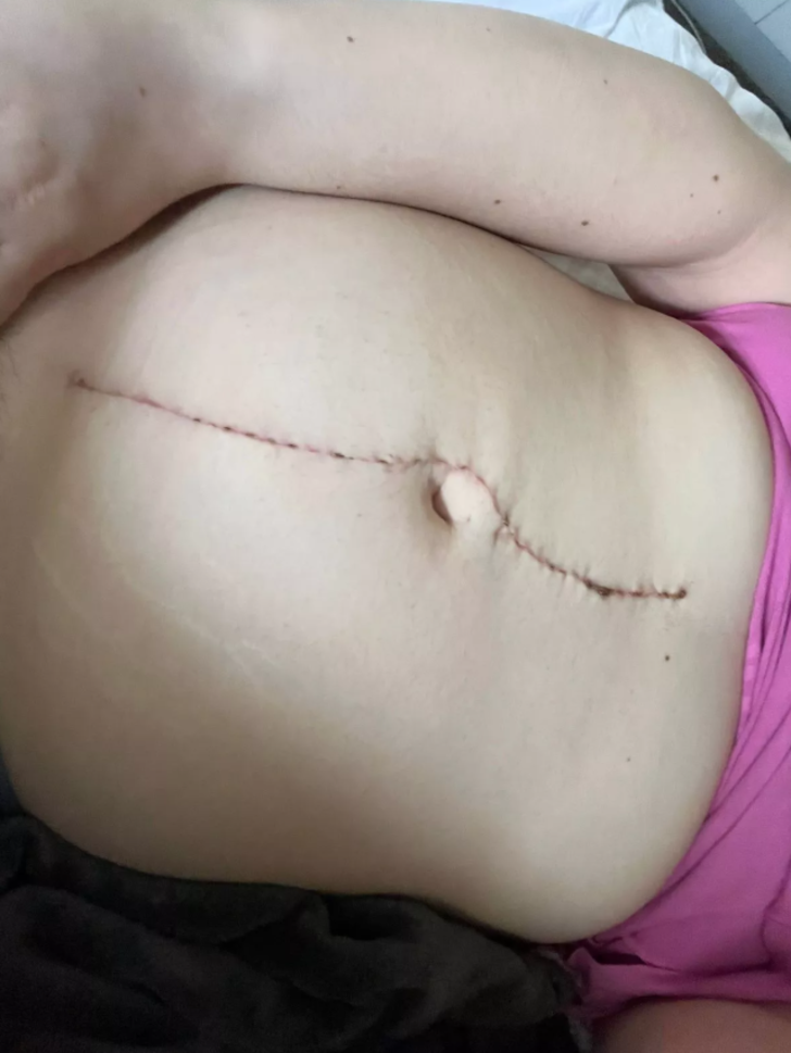 Hamile olduğunu sandılar! Karnından çıkanı gören uzaylıya benzetti: Tam 19 kilo!  G4