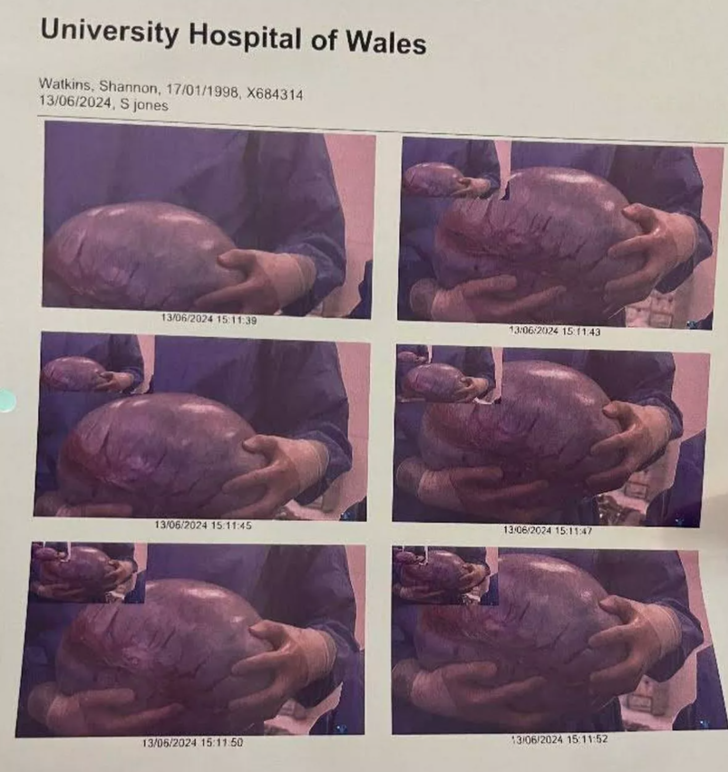 Hamile olduğunu sandılar! Karnından çıkanı gören uzaylıya benzetti: Tam 19 kilo!  G3