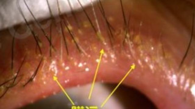 Kirpik diplerinde sarı lekeler fark etti! Kirpiklerinden böcek çıkınca şoke oldu: Ne yapacağımı bilemedim