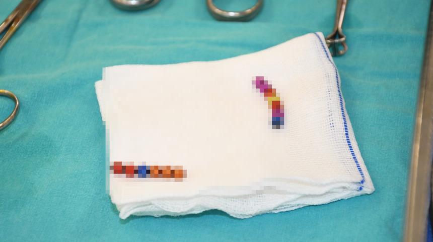 Akılalmaz olayın adresi bu kez Yozgat! 4 yaşındaki çocuğun bağırsağından çıkanlar hayrete düşürdü! Tam 13 adet