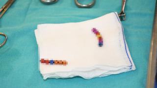 Akılalmaz olayın adresi bu kez Yozgat! 4 yaşındaki çocuğun bağırsağından çıkanlar hayrete düşürdü! Tam 13 adet