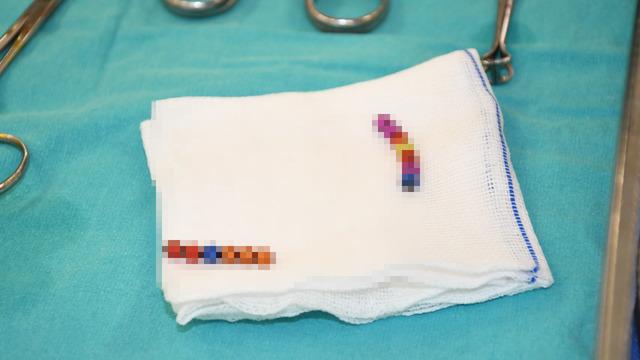 Akılalmaz olayın adresi bu kez Yozgat! 4 yaşındaki çocuğun bağırsağından çıkanlar hayrete düşürdü! Tam 13 adet