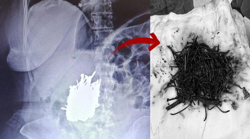 Çivi, demir, kolye ve toka... Hepsi midesinden çıktı! Engelli kadın karın ağrısıyla gittiği hastaneden 1 kilo metal ile çıktı