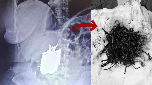 Çivi, demir, kolye ve toka... Hepsi midesinden çıktı! Engelli kadın karın ağrısıyla gittiği hastaneden 1 kilo metal ile çıktı