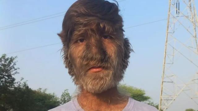 Orta Çağ'dan beri nadir görülüyordu: 11 bebekte Kurt adam sendromu çıktı! Sebebi bakın neymiş