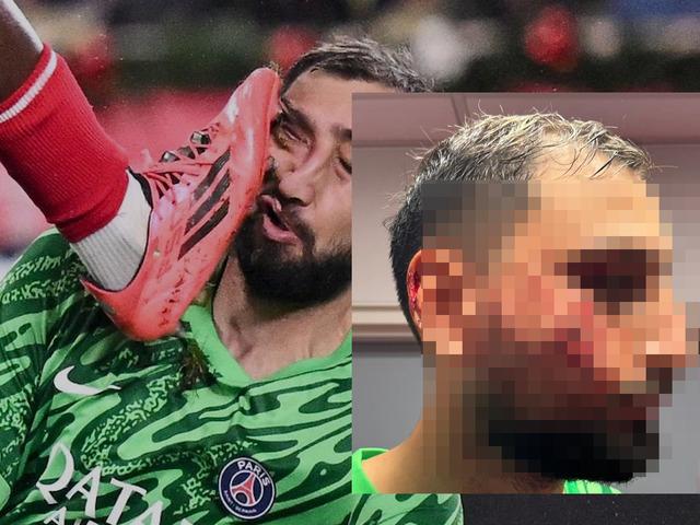 Donnarumma'nın maçta ağzı yüzü dağıldı! Son hali tanınmıyor...