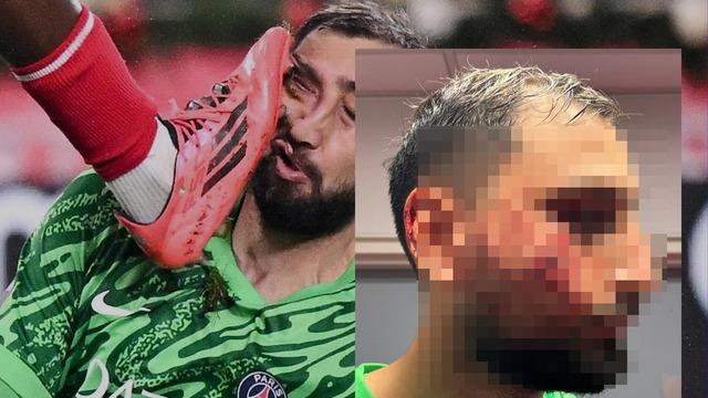 Donnarumma'nın maçta ağzı yüzü dağıldı! Son hali tanınmıyor...