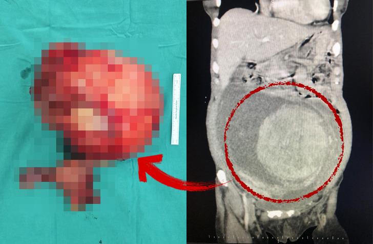 Karın ağrısıyla gitti! Karnından çıkana inanamadı: Tam 6 kilo ağırlığında!