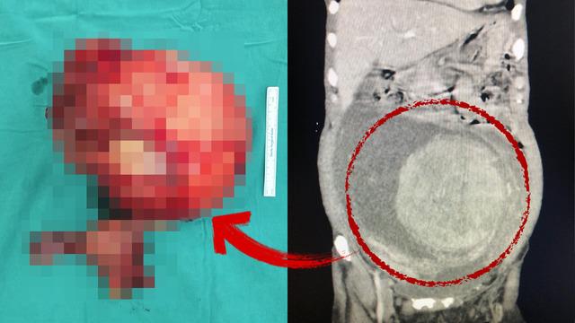 Karın ağrısıyla gitti! Karnından çıkana inanamadı: Tam 6 kilo ağırlığında!