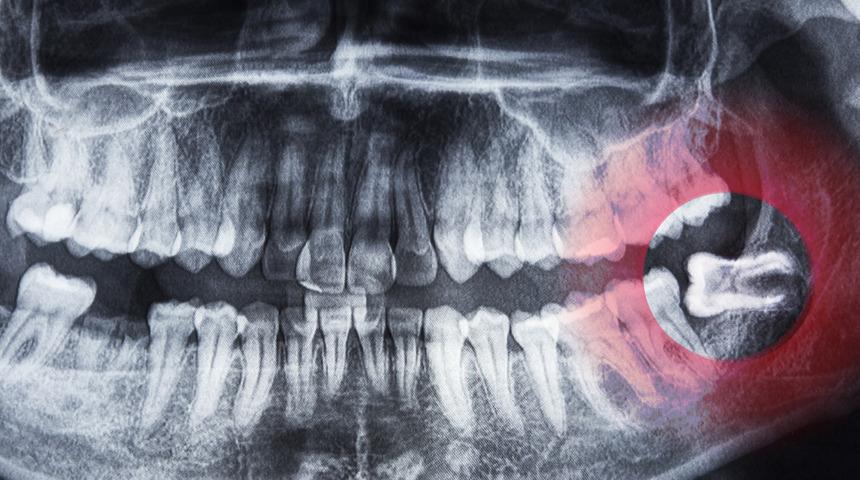 Gömülü dişiniz varsa dikkat! Tedavi edilmezse ciddi sağlık sorunlarına yol açabilir