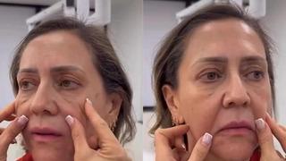 50 yaşındaki kadın estetikle bambaşka biri oldu! Önceki ve sonraki halini görenler gözlerine inanamadı! 30 yaş gençleşti yorum yağdı...