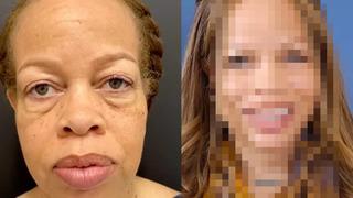 57 yaşındaki kadının estetik operasyonlardan önceki ve sonraki görüntüsü şoke etti! Bu nasıl 57 yaş?