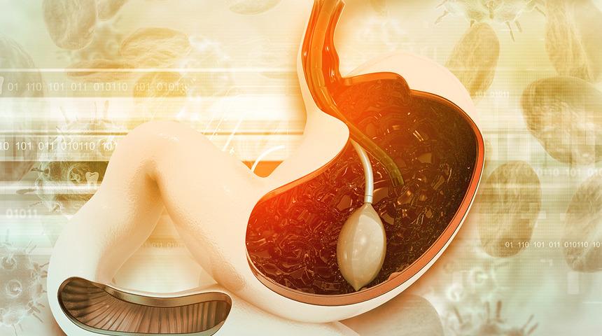 Fransa'da yasaklandı, tüm Avrupa'da yasaklanması için harekete geçildi! Mide balonu sistemi Türkiye'de de durduruldu