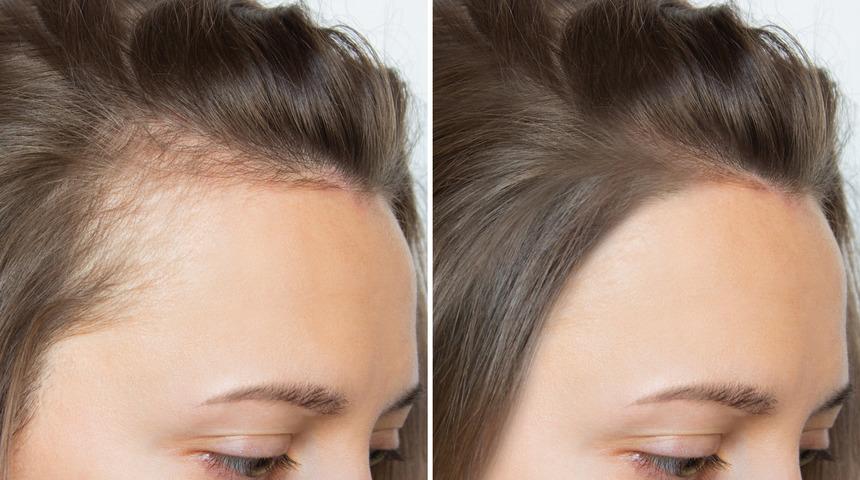 Saç dökülmesine karşı dermatologlar bunu öneriyor! Sağlıklı uzayan saçlar için...