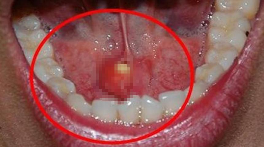 Ağızdaki sessiz tehlike: Tedavi edilmezse kötü sonuçlara neden oluyor!