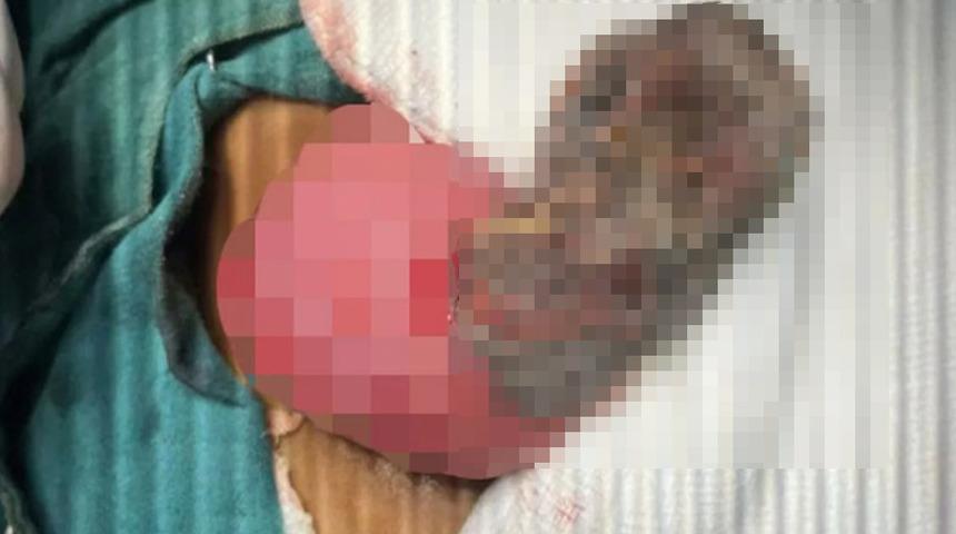 4 yaşındaki çocuğun midesinden saç yumağı çıktı! Doktorları şaşkına çevirdi: "Kuyruğu bile vardı"