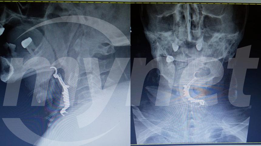 İddia çok büyük... Öyle bir şey unuttular ki ölüme sebep oldu! Üstüne evrakla sahtecilikle olay örtbas edildi