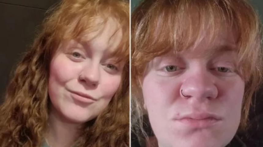 Sosyal medyayı şaşırtan görüntü! Hamilelikten sonra burun ölçüleri değişti: "Burnum iki katına çıktı"