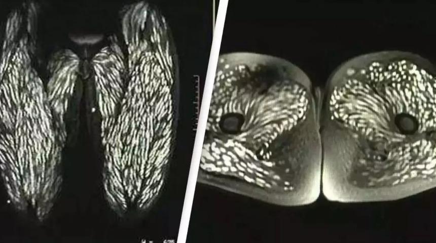 10 yıl boyunca çiğ domuz eti yedi! Tarama sonuçları şaşkına çevirdi: Bütün vücudunu canlı parazitler kapladı