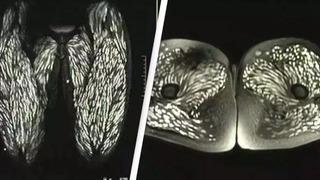 10 yıl boyunca çiğ domuz eti yedi! Tarama sonuçları şaşkına çevirdi: Bütün vücudunu canlı parazitler kapladı