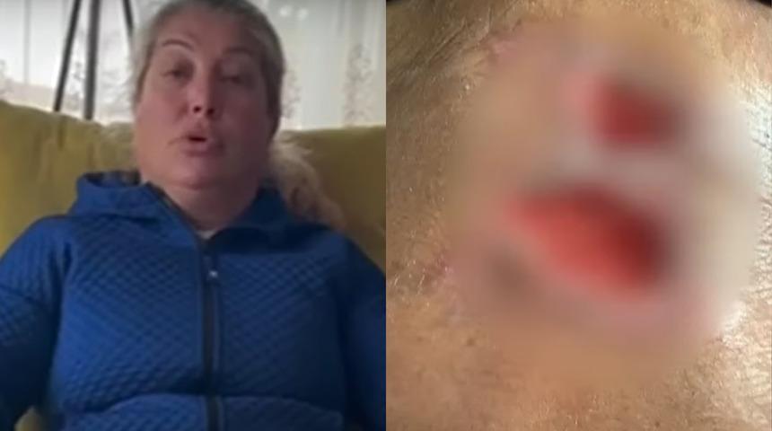 Estetik değil adeta facia! Güzelleşmek isterken karnı çürümeye, etleri dökülmeye başladı!