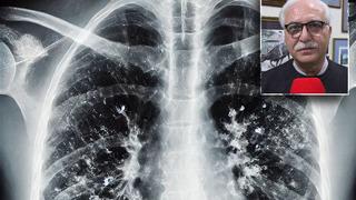 4 saat içinde tedaviye başlanmazsa ölümle sonuçlanabiliyor! Mevsimsel hastalıkların en ağırı buymuş! Griple karıştırmayın