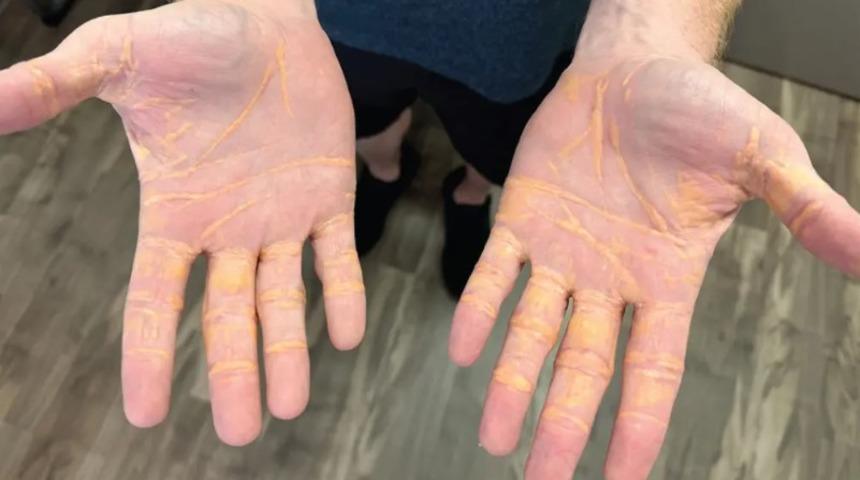 8 ay boyunca sadece peynir, dana eti ve tereyağı yedi! Şoke edici yan etkilerini gösterdi... Sosyal medya onu konuşuyor 