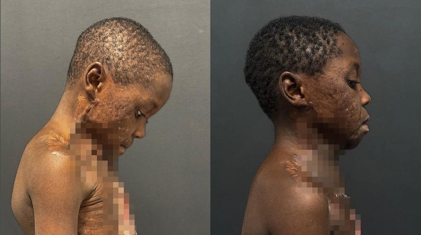 Boynu yanınca çenesi gövdesine yapıştı! Kafasını dahi kaldıramaz hale geldi