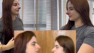 Burun estetiğinden sonraki hali görenleri şaşkına çevirdi! Çok konuşulan operasyon: Eskisi daha iyiymiş 