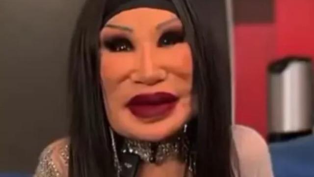 Eski halini görenler inanamadı! Estetik operasyon öncesi ve sonrası paylaşıldı: Ne yapmışsın kendine?