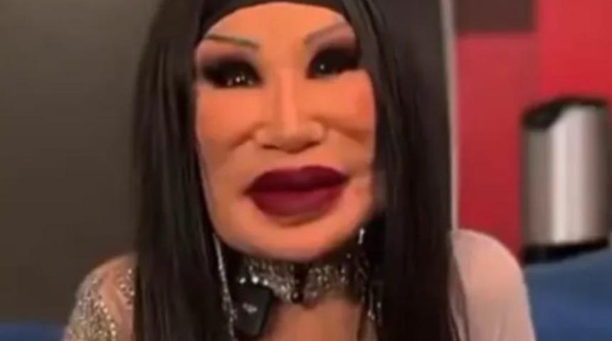 Eski halini görenler inanamadı! Estetik operasyon öncesi ve sonrası paylaşıldı: "Ne yapmışsın kendine?"